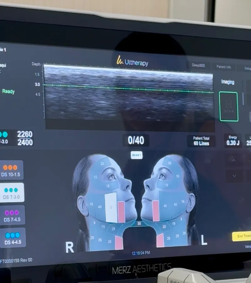 Pantalla del equipo Ultherapy PRIME con la imagen ecográfica de las capas de la piel y el mapa facial por zonas.