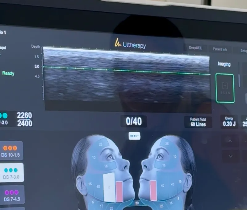 Pantalla del equipo Ultherapy PRIME mostrando la imagen ecográfica de las capas de la piel durante la sesión.