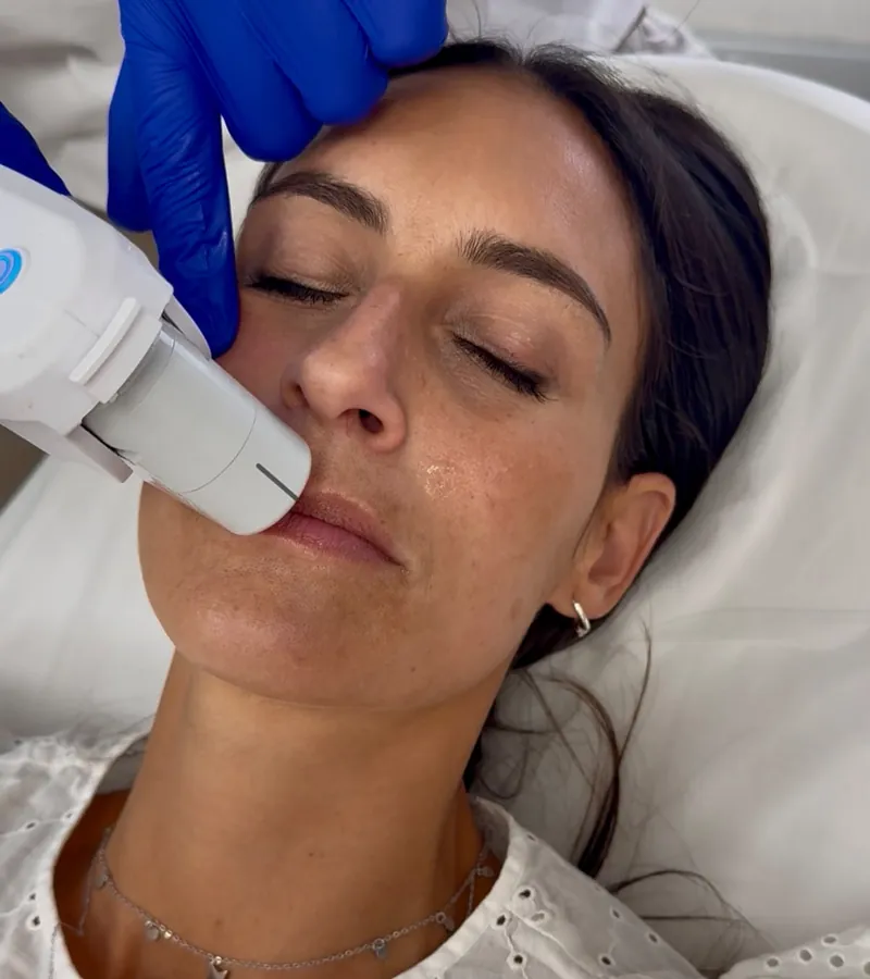Paciente recibiendo Ultherapy PRIME en la mandíbula, tumbada en la camilla con los ojos cerrados, en Estetikap Málaga.